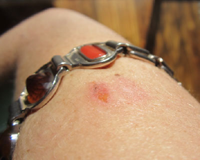 Rash possibly caused by frequency bangle